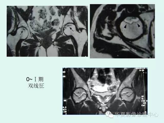 【PPT】股骨头缺血性坏死