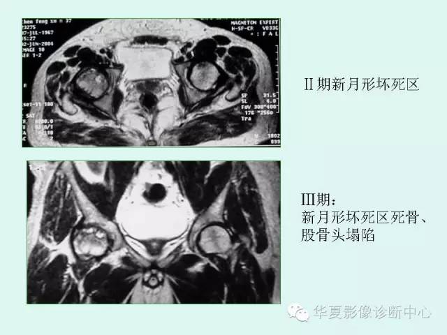 【PPT】股骨头缺血性坏死