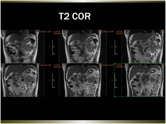 【病例】腹膜恶性间皮瘤1例MR影像表现