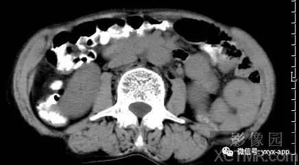 【病例】阑尾粘液囊肿1例CT影像诊断