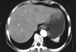 【病例】肝多发海绵状血管瘤1例CT
