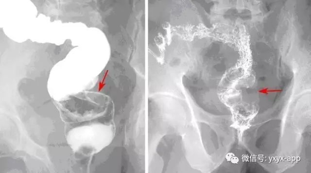 【病例】直肠癌1例X线CT影像表现