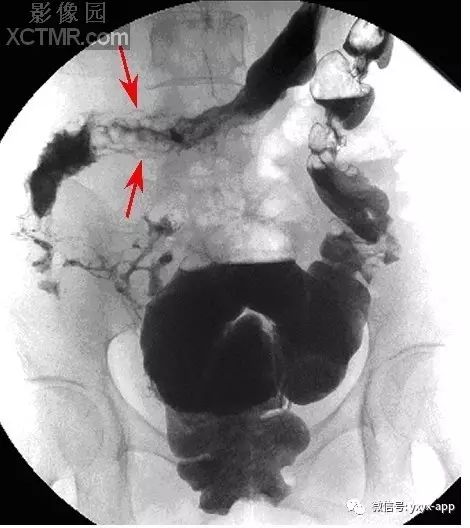 【病例】克罗恩病1例X线钡灌肠影像诊断分析