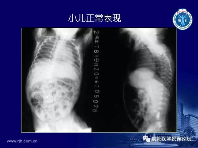 【PPT】急腹症
