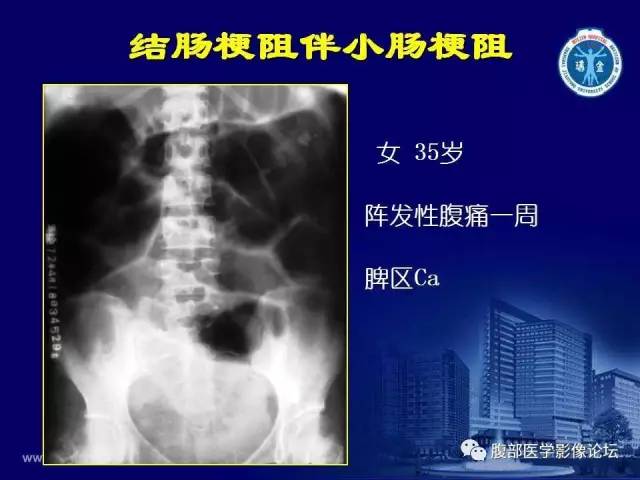 【PPT】急腹症
