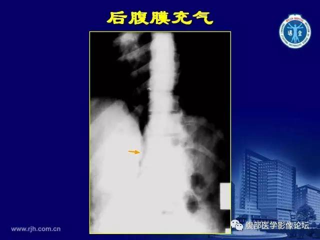 【PPT】急腹症