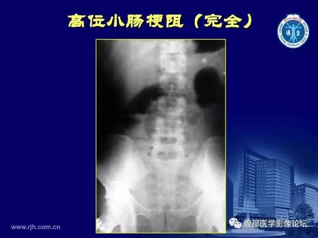 【PPT】急腹症