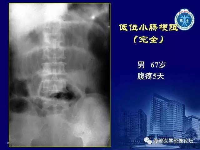 【PPT】急腹症