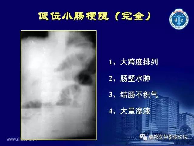 【PPT】急腹症