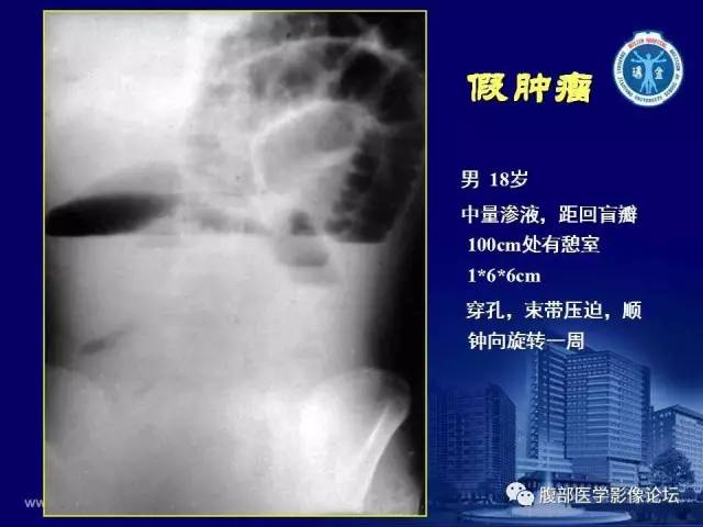 【PPT】急腹症