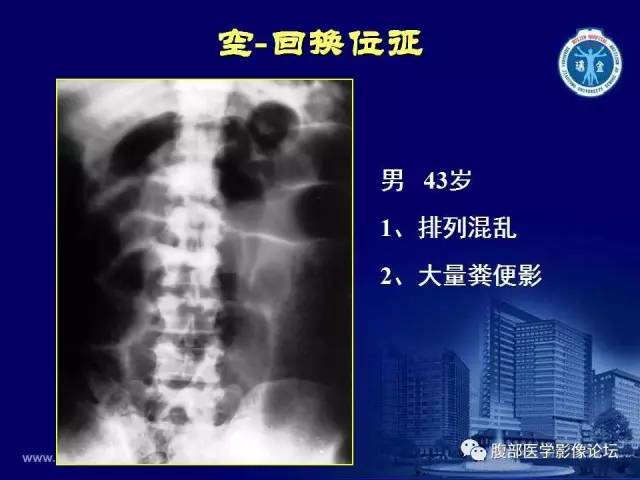 【PPT】急腹症