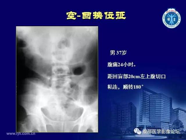 【PPT】急腹症