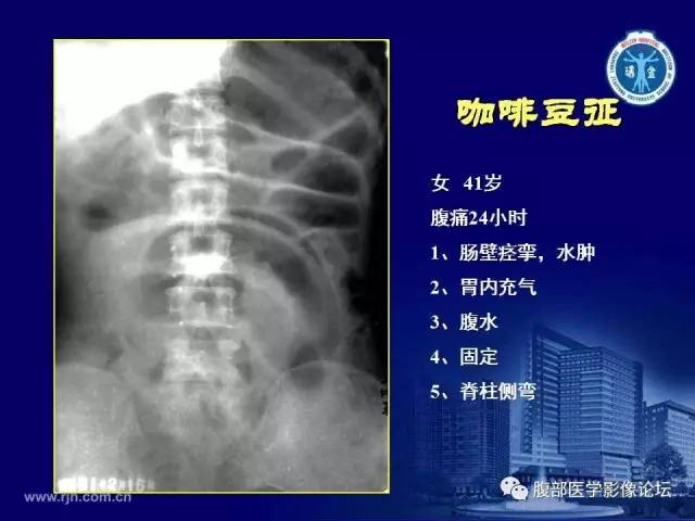 【PPT】急腹症