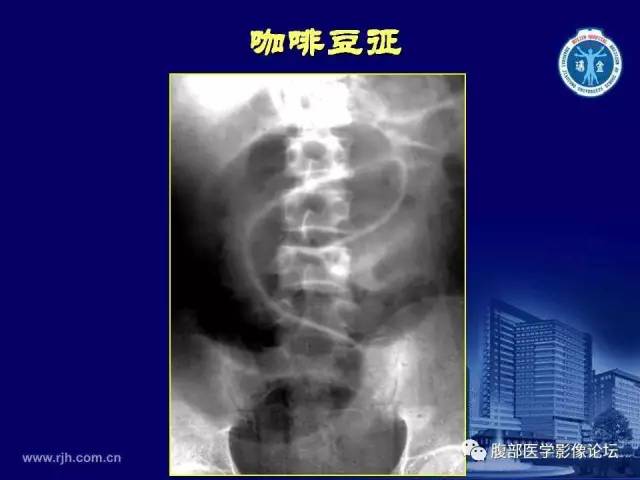 【PPT】急腹症