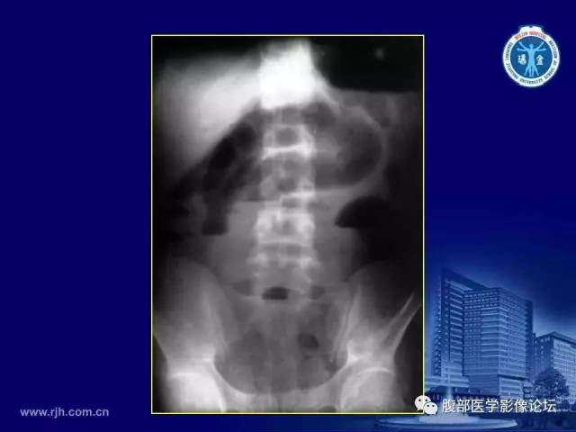 【PPT】急腹症