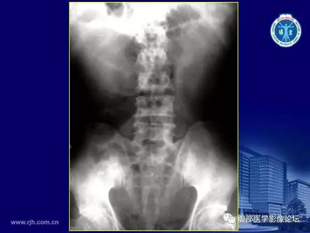 【PPT】急腹症