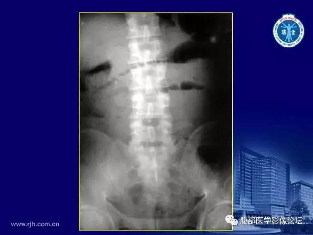 【PPT】急腹症
