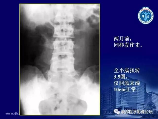 【PPT】急腹症
