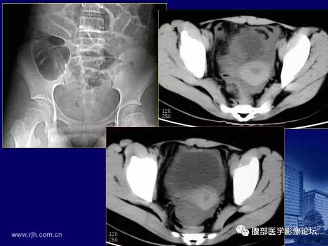 【PPT】急腹症