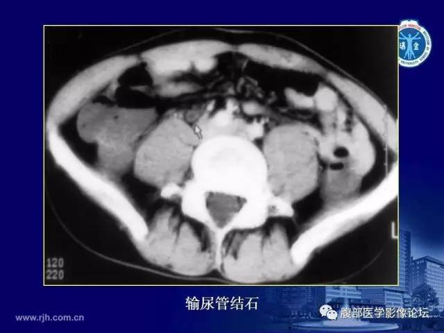 【PPT】急腹症