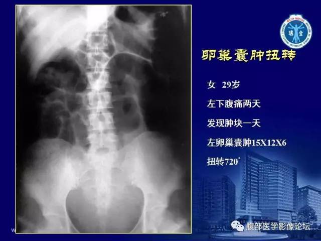 【PPT】急腹症