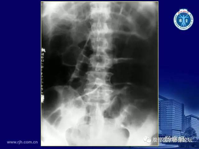 【PPT】急腹症