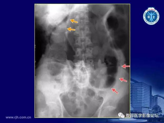 【PPT】急腹症