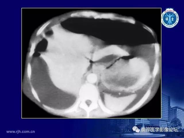 【PPT】急腹症