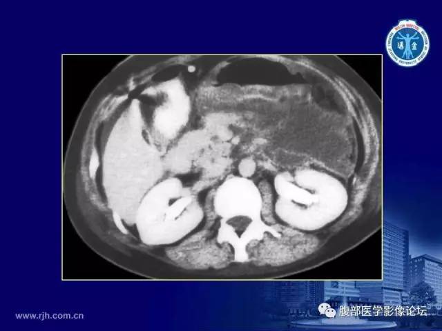 【PPT】急腹症
