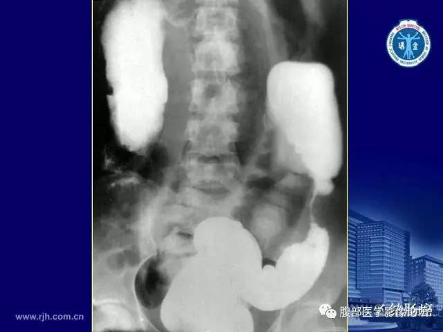 【PPT】急腹症