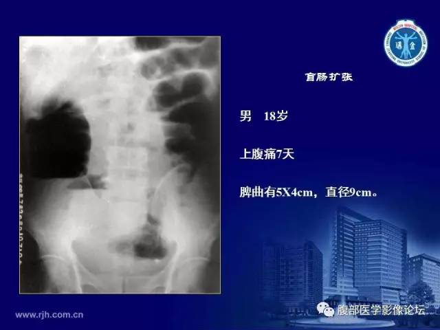 【PPT】急腹症