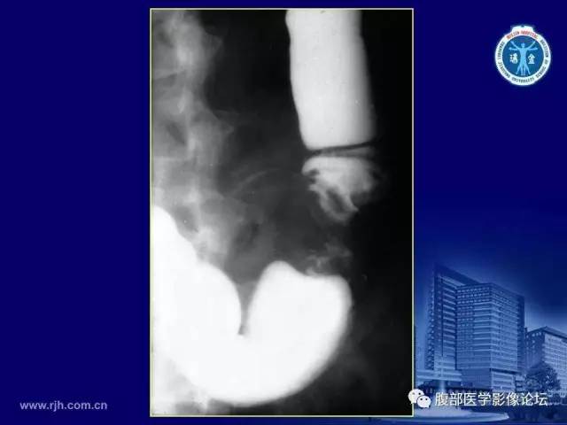 【PPT】急腹症