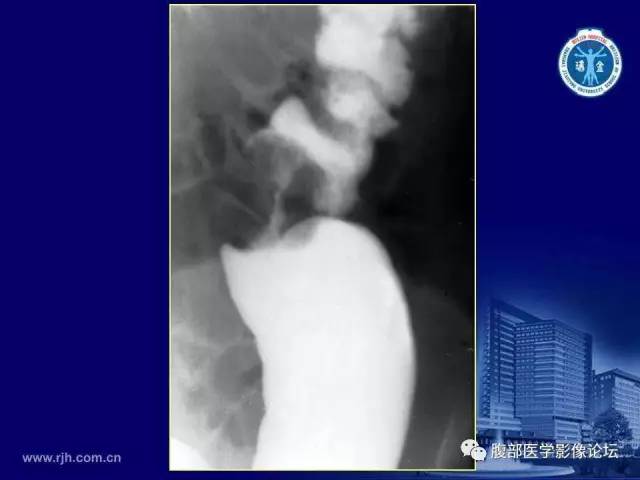 【PPT】急腹症