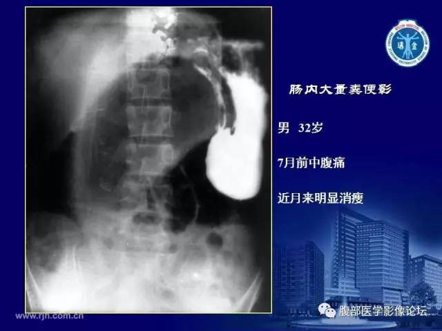 【PPT】急腹症