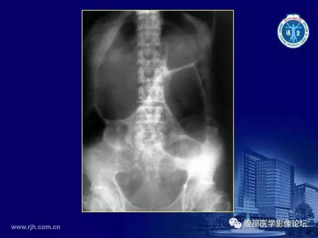 【PPT】急腹症