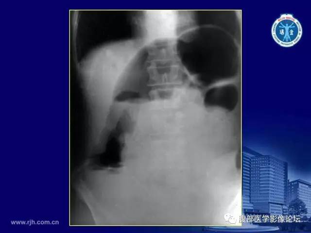【PPT】急腹症