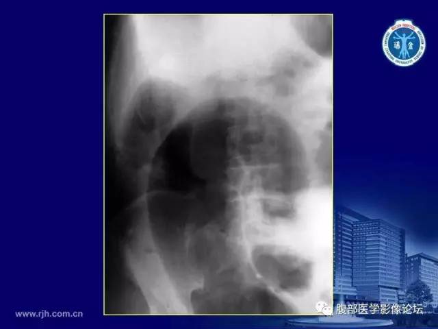 【PPT】急腹症