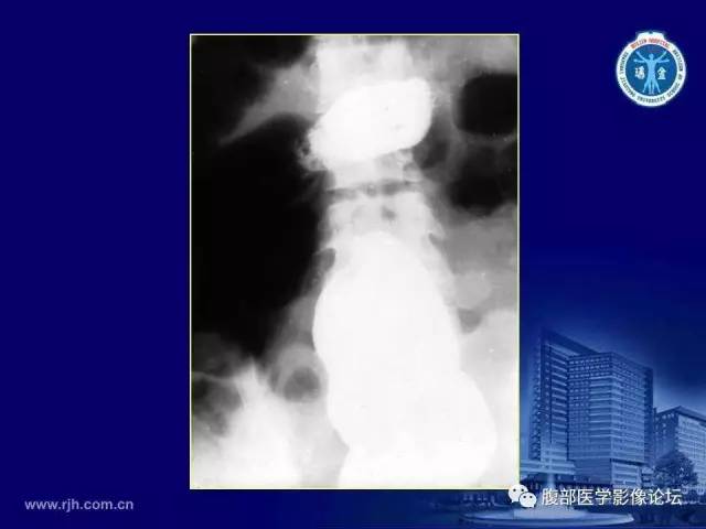 【PPT】急腹症