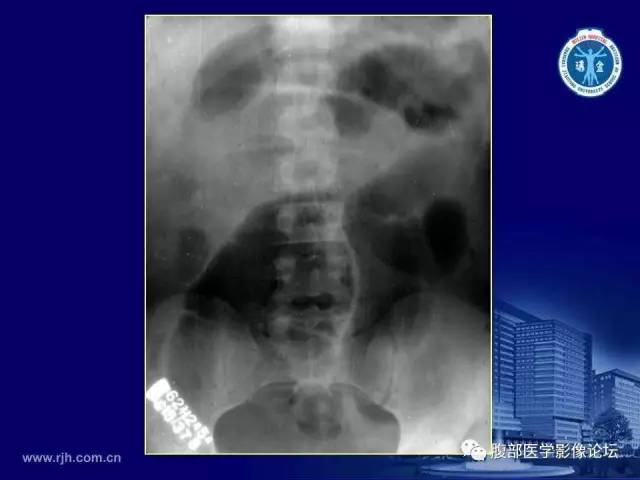 【PPT】急腹症