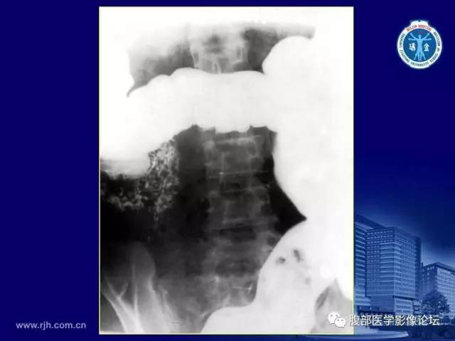【PPT】急腹症