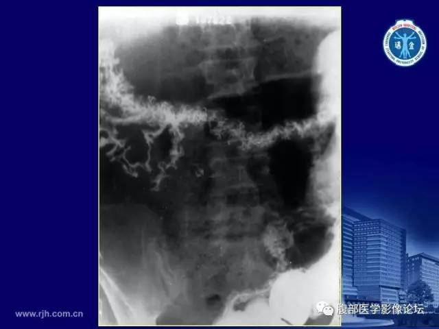 【PPT】急腹症