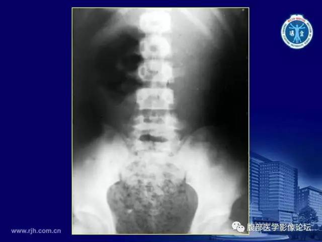 【PPT】急腹症