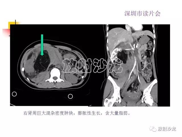 【病例】右肾血管平滑肌脂肪瘤1例CT影像表现