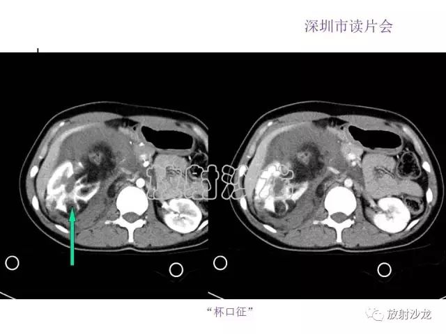 【病例】右肾血管平滑肌脂肪瘤1例CT影像表现