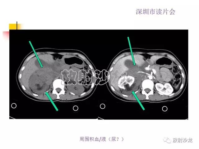 【病例】右肾血管平滑肌脂肪瘤1例CT影像表现