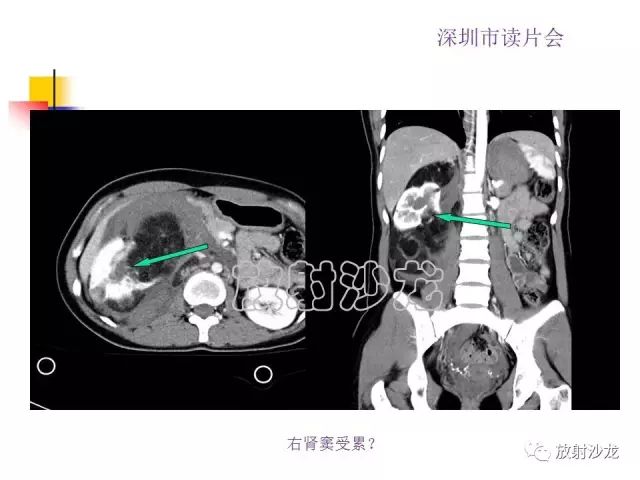 【病例】右肾血管平滑肌脂肪瘤1例CT影像表现