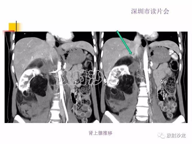 【病例】右肾血管平滑肌脂肪瘤1例CT影像表现