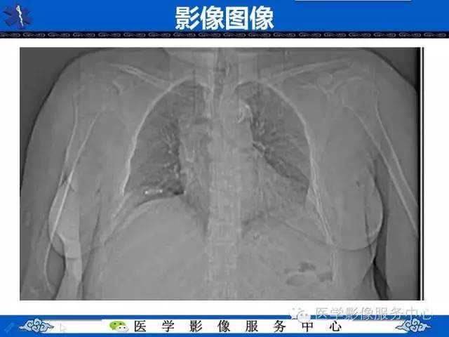 【病例】肝区异位节育器1例CT
