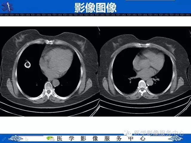 【病例】肝区异位节育器1例CT