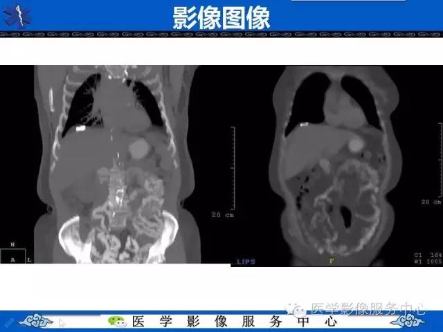 【病例】肝区异位节育器1例CT